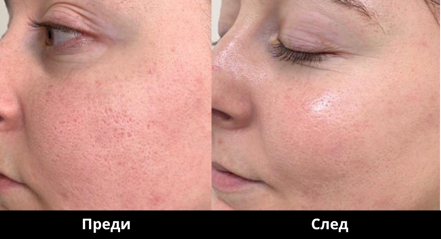 DermaPen1_Преди и след Derma Gold