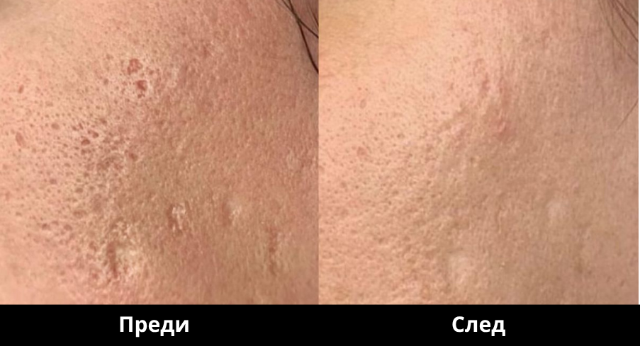DermaPen2_Преди и след Derma Gold