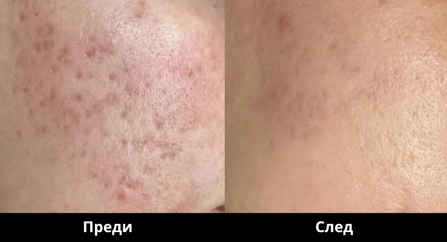 DermaPen3_Преди и след Derma Gold