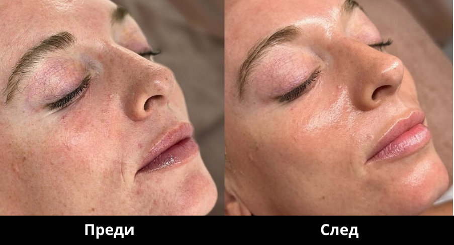 Преди и след Derma Gold - 15