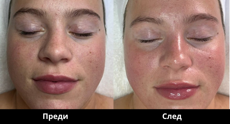 Преди и след Derma Gold - 16