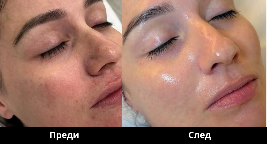 Преди и след Derma Gold - 17