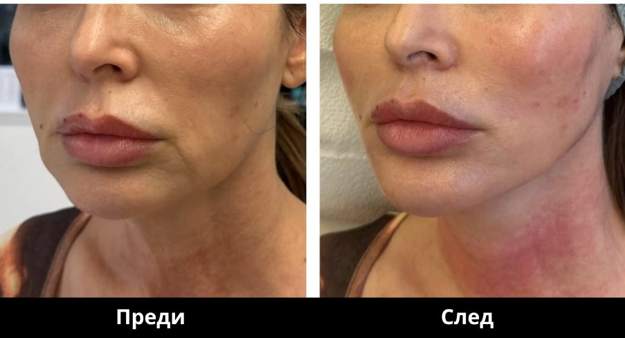 Преди и след Derma Gold - 12