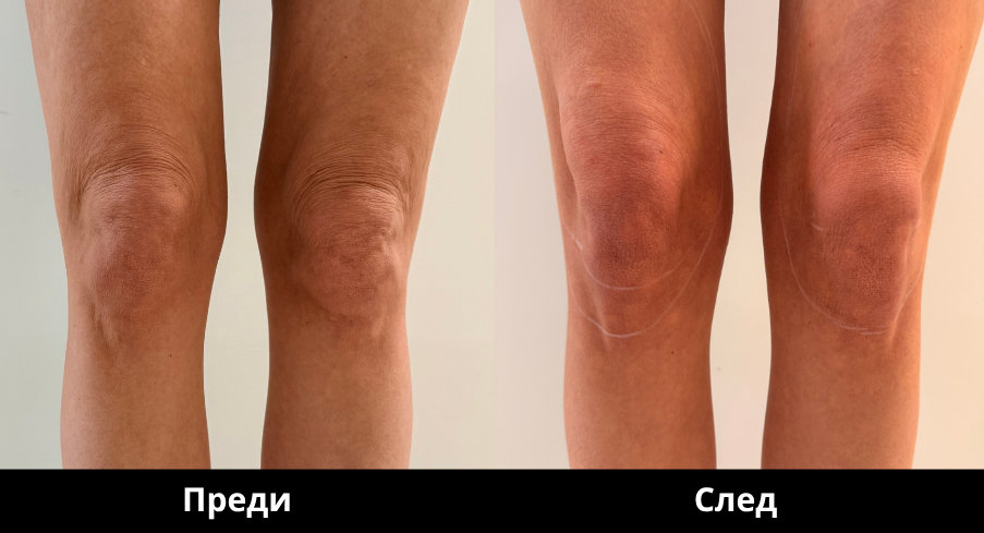 Преди и след Derma Gold - 13