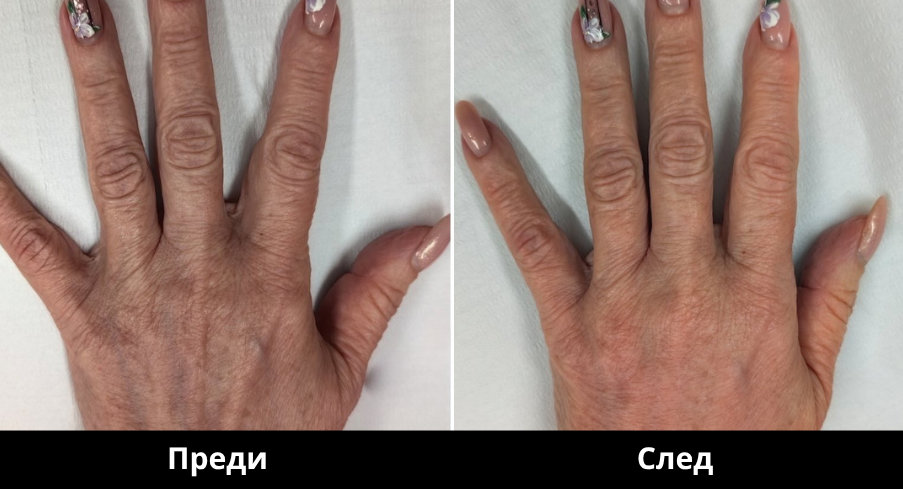 Преди и след Derma Gold - 15